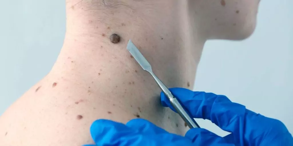 Удаление доброкачественных новообразований подкожной клетчатки